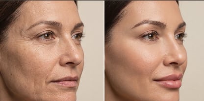Botox treatment results