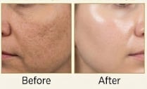 HydraFacial Before & After