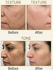 Laser Resurfacing Before & After